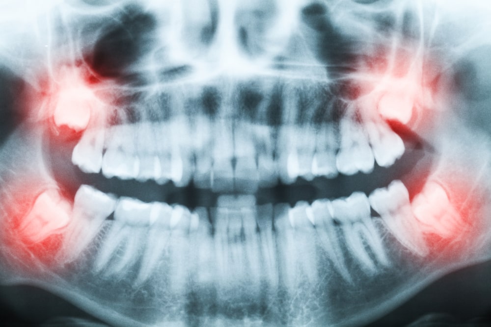 Radiographies des mâchoires montrant les dents de sagesse
